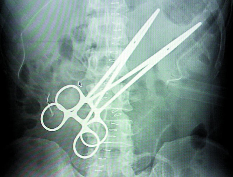 Инородное тело брюшной полости после операции. Инородный предмет в теле. Рентген с металлическими предметами. Инородные предметы на рентгене. Забытые инородные тела в хирургии.